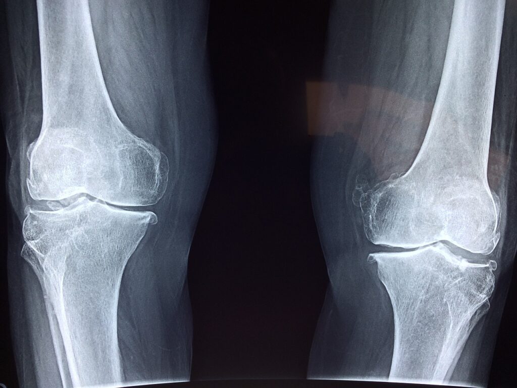 Key Nutrients For Maintaining Joint Health And Flexibility